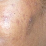 cicatrices d'acné, que faire?